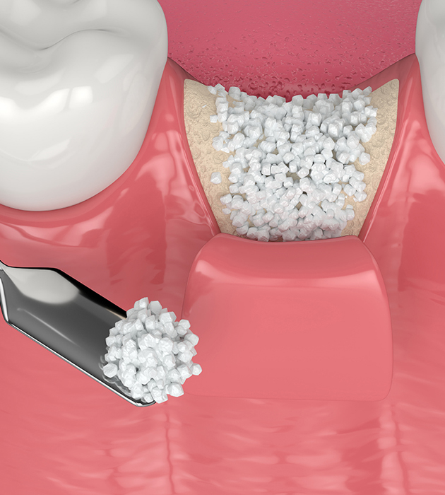 Dental composite resin beads displayed in pink container with applicator tool and white cap.