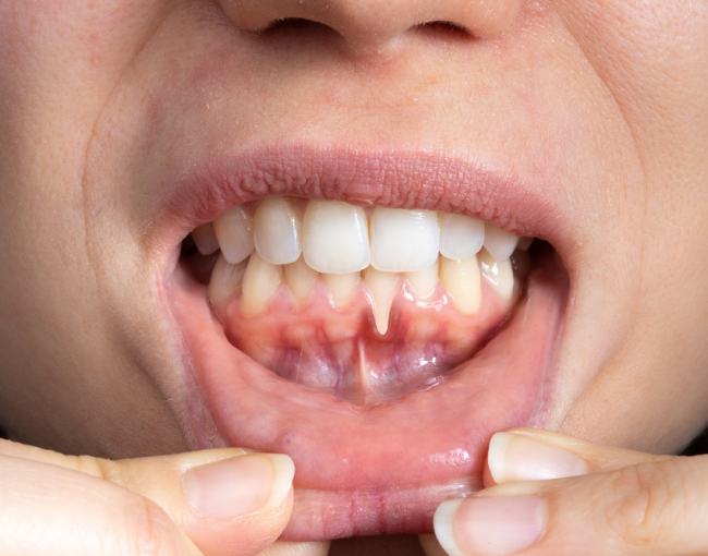 Close-up of open mouth showing teeth and gums during dental examination or consultation.