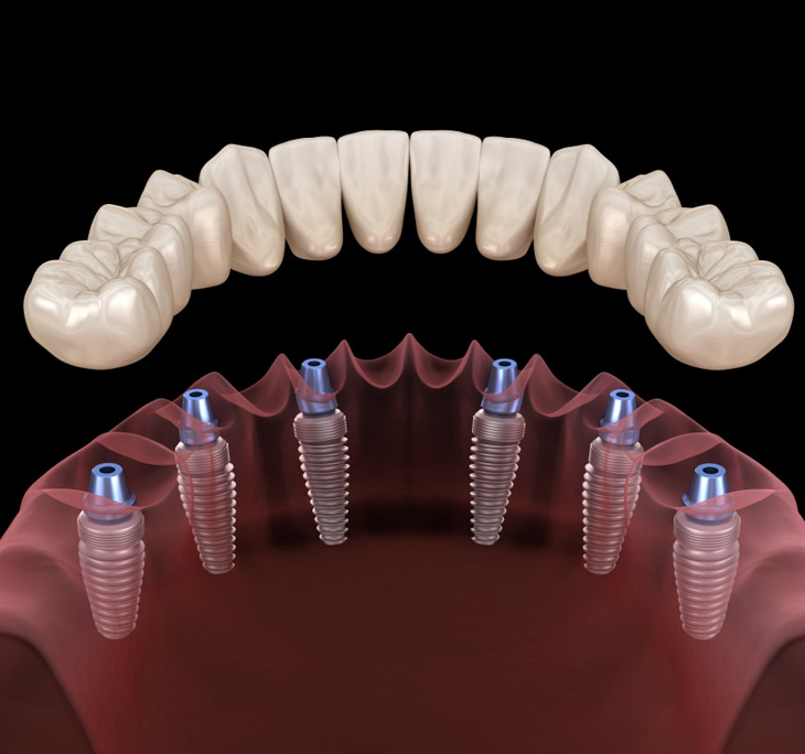 Digital illustration of full dental implant bridge with multiple titanium posts on gum model.