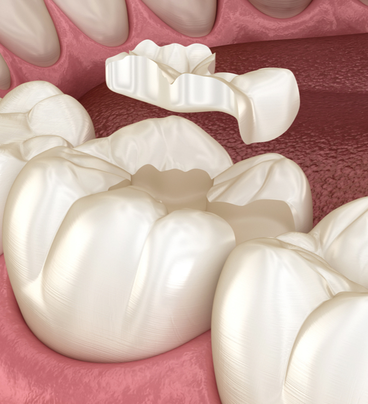 Dental crowns and bridge restoration model showing tooth replacement procedure in clinical setting.