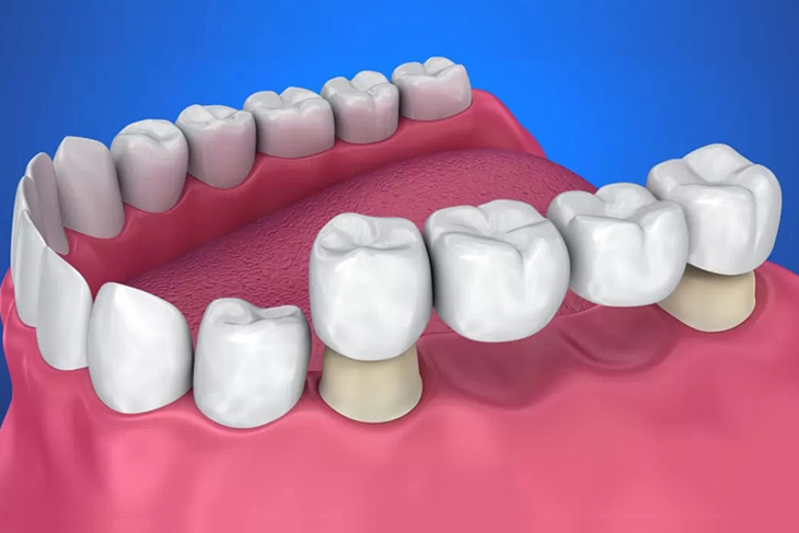 3D dental bridge model showing tooth replacement on blue and pink background