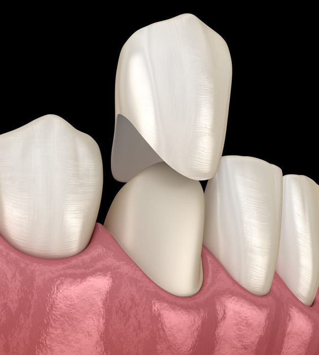 Dental crown restoration showing tooth-colored ceramic crown placed on implant over pink gum tissue model.
