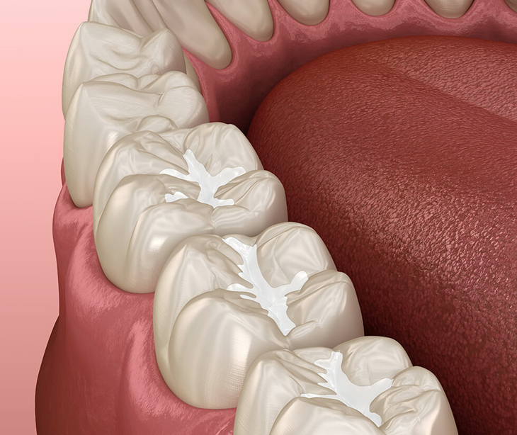 Close-up of white dental crowns displayed against pink background showing dental restoration options.