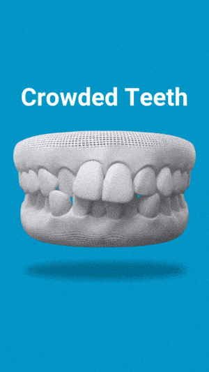 3D dental model showing crowded teeth condition on blue background with label.
