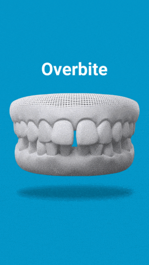 Dental model showing overbite malocclusion on blue background for educational purposes.